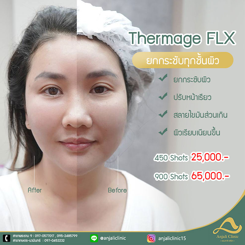 pro-thermage-flx-june-2022